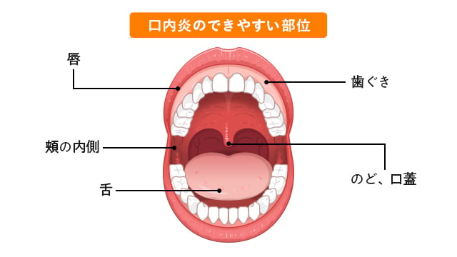 1_口内炎のできやすい部位の図