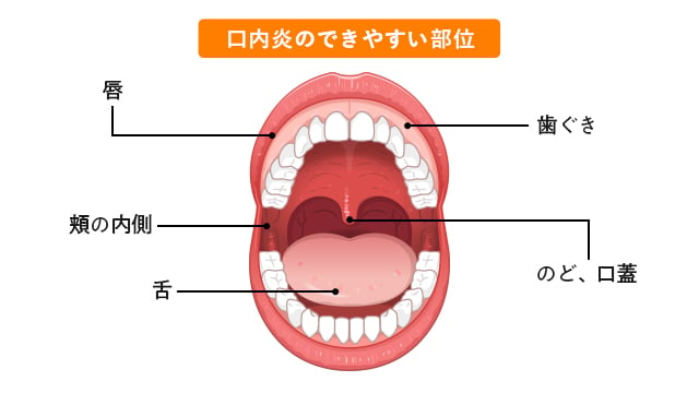 歯茎 の 腫れ 販売 チョコラ bb